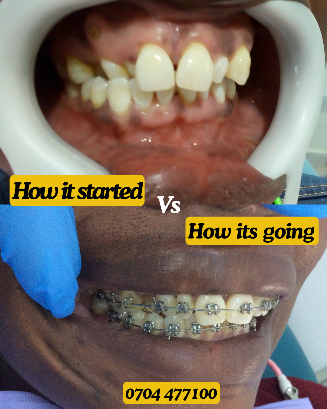 Braces transformation 4b